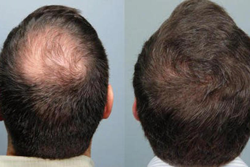What is the newest method of treating hereditary hair loss?