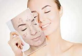 پماد از بین بردن لکه های قهوه ای جای جوش