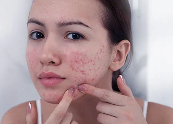 کرم ترمیم کننده صورت برای پوست های آسیب دیده از شانه زدن