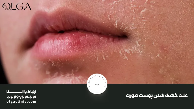 علت خشک شدن پوست صورت