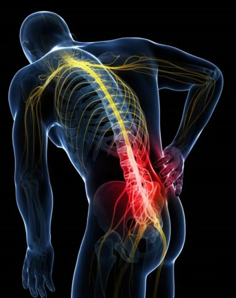 چه زمانی دیسک کمر نیاز به عمل دارد؟
