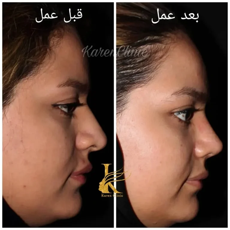 چه کسانی نباید عمل بینی انجام دهند؟