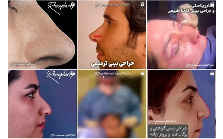 برای عمل بینی جراح پلاستیک بهتر است یا متخصص گوش و حلق و بینی؟ 
